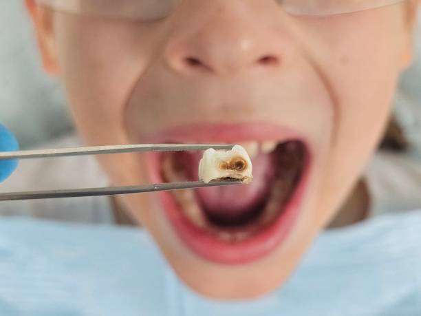 Best Broken or Chipped Tooth Repair in West Orange, TX