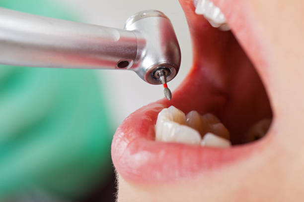 Best Emergency Wisdom Tooth Extraction in West Orange, TX